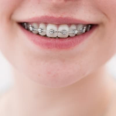 BRACES