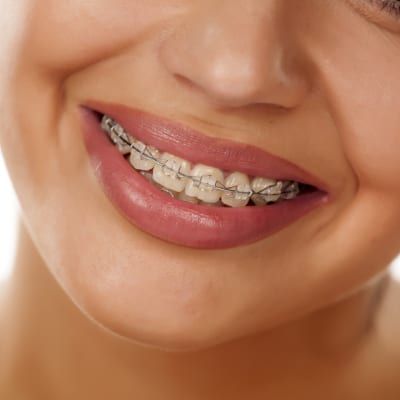 CLEAR LINER BRACES